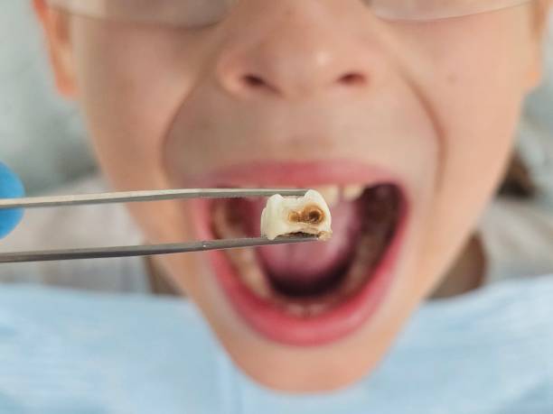 Best Emergency Tooth Extraction in Jasper, AL